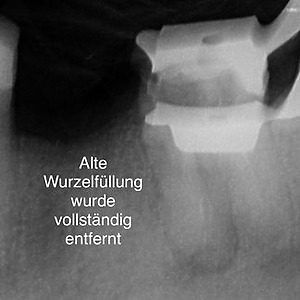 Entfernte alte Wurzelfüllung bei Revision eines Zahns