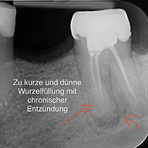 Röntgenbild einer Wurzelfüllung mit chronischer Entzündung an der Wurzelspitze