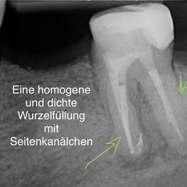 Homogene und dichte Wurzelfuellung mit Seitenkanälchen